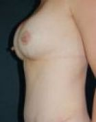 breast-aug-7-after-scarless