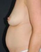 breast-lift-2-before-scarless