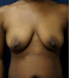 breast-lift-5-before