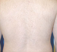 laser-hair-removal-4a
