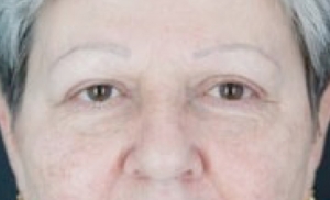 brow-lift-after