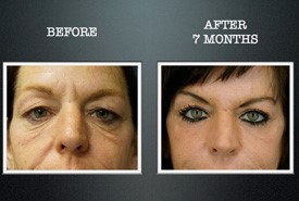 eyelid-surgery-before-and-after