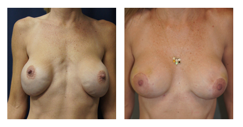 breast-revision-2