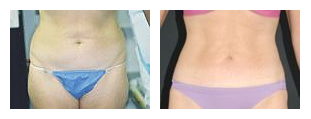 SlimLipo Laser Liposuction Specials at Obi Plastic Surgery