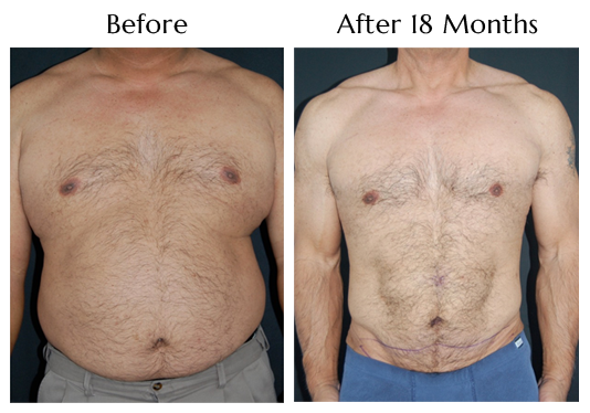 SlimLipo For Men at Obi Plastic Surgery!
