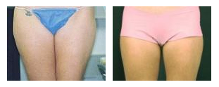 SlimLipo for Thighs at Obi Plastic Surgery