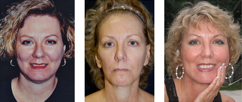 14 Year Opera Lift Face Lift Patient Study