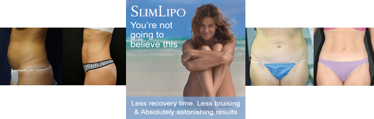 Slim Lipo Laser Liposuction in Jacksonville