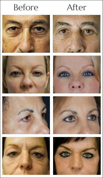 Browlift Before and After by Dr. Lewis J. Obi in Jacksonville