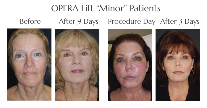 The OperaLift Minor Non Surgical Face Lift at Obi Plastic Surgery