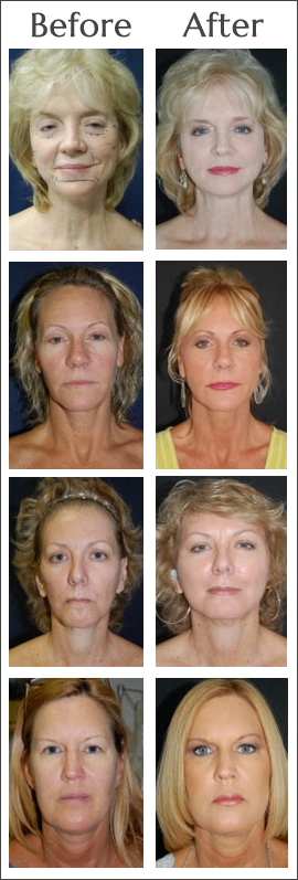 Facial Fat Transfer Before and After