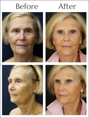 Platelet Rich Plasma Therapy at Obi Plastic Surgery in Jacksonville