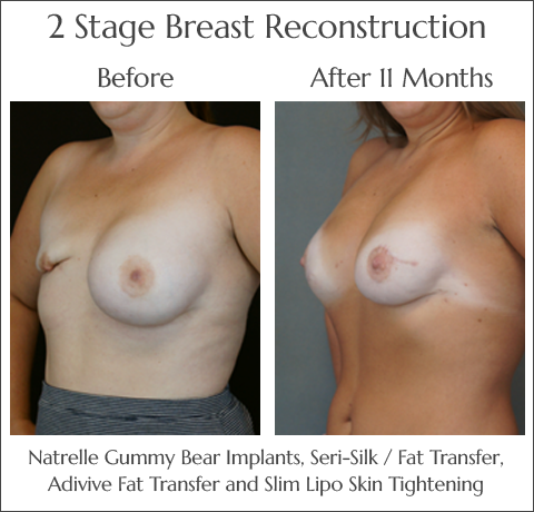 Breast Reconstruction in Jacksonville at Obi Plastic Surgery