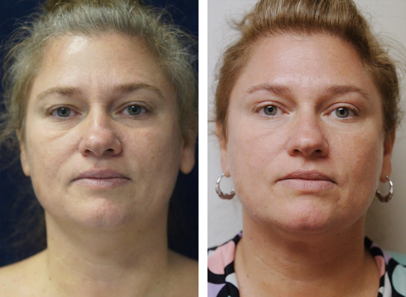 Non-Surgical OperaLift Facelift by Dr. Lewis J. Obi in Jacksonville