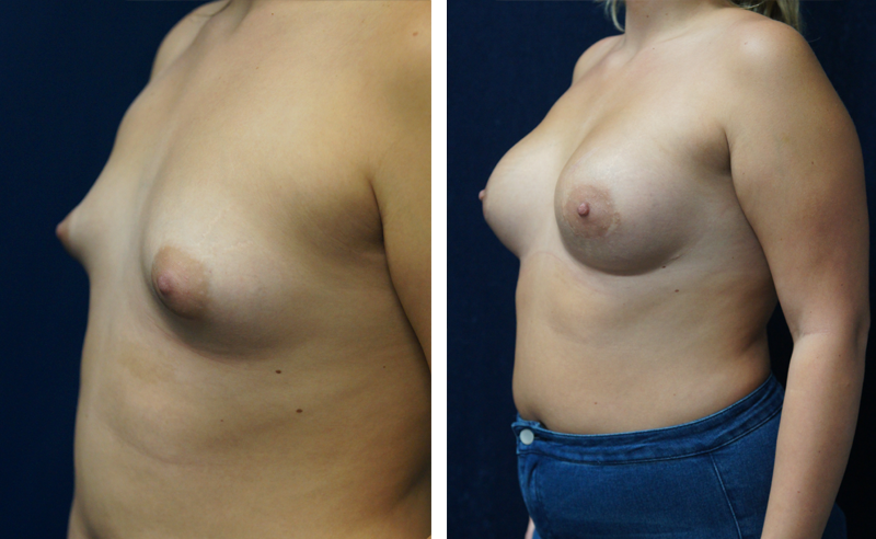 Breast Augmentation by Dr. Lewis J. Obi in Jacksonville, FL