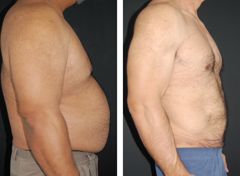 Lipo Shots Before And After