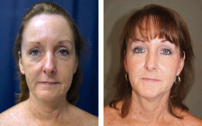 Non-Surgical OperaLift Facelift by Dr. Lewis J. Obi in Jacksonville