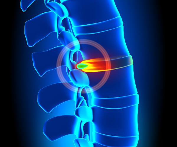 Spinal Stem Cell Therapy