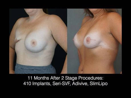 11 months after 2 stage procedure