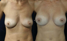 areolar scarless breast augmentation