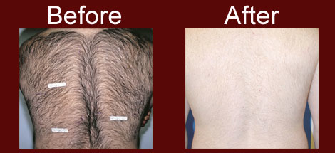 back hair removal