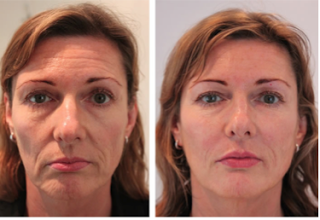 voluma before and after