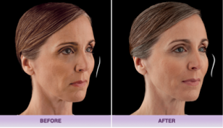voluma before and after