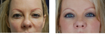 voluma before and after