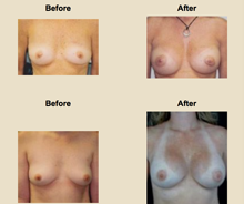 breast augmentation before and after