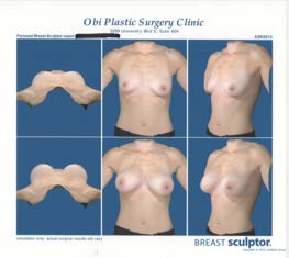 Breast Sculptor 3D imaging