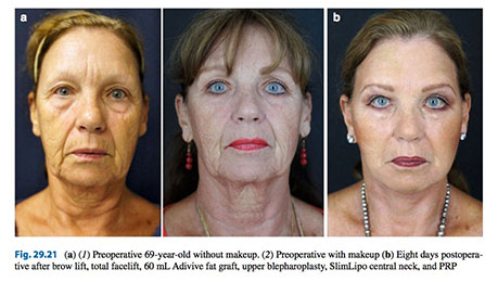 brow lift