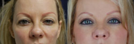 browlift before and after