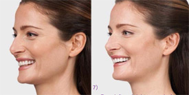 browlines before and after