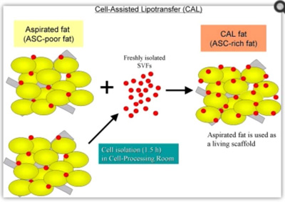 cell-assisted lipotransfer