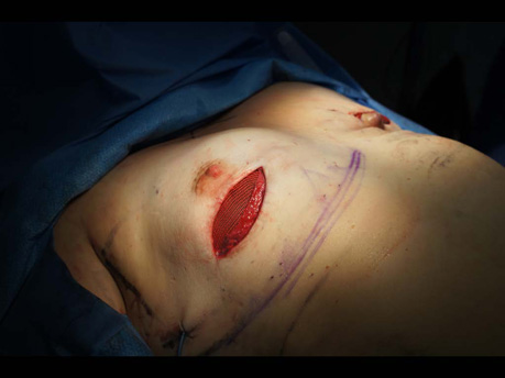 during breast surgery
