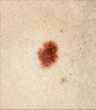 dysplastic nevus