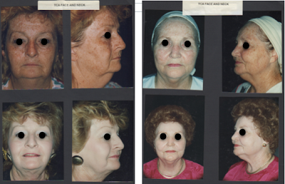 facelift and phenol peel