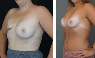 failed breast reconstruction before and after