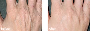 fat injections hands before and after