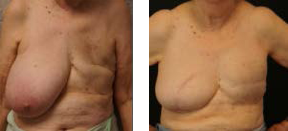 first stage breast reconstruction