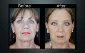 full surgical facelift before and after
