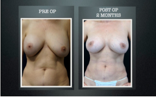 implant before and after