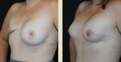 implants before and after