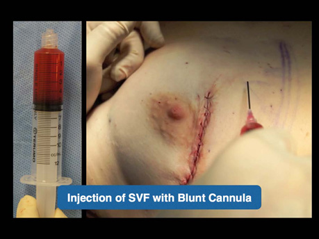 Injection of SVF with Blunt Cannula