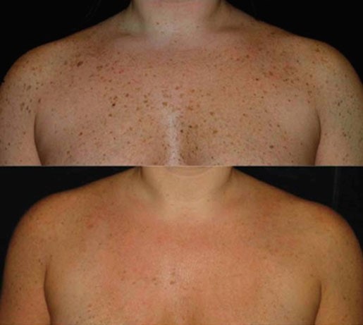 IPL before and after