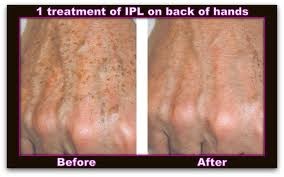 IPL before and after