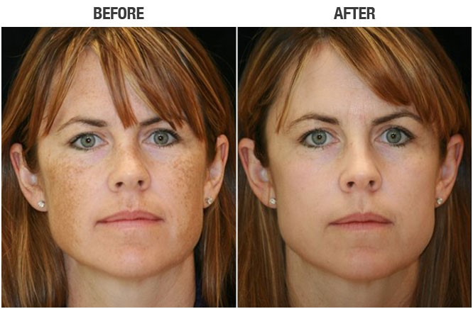 IPL before and after