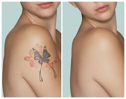 laser tattoo removal butterfly