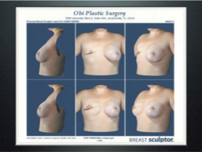 vectra 3d mastectomy reconstruction