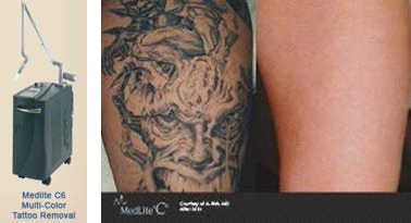 medline C6 multi-color tattoo removal